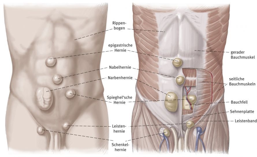 Hernienarten Hernienarten
