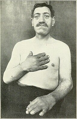 Male acromegaly patient (1904)