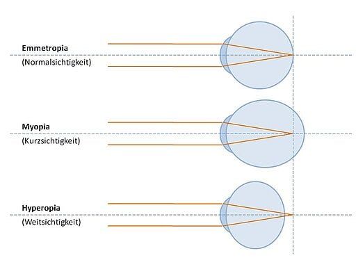 Refractive errors