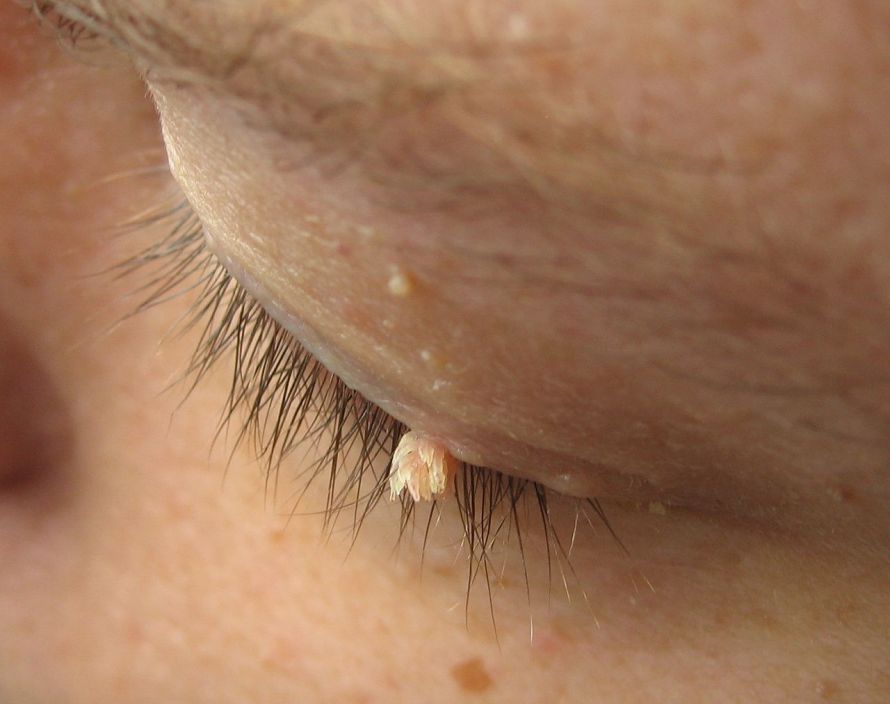 Pillow wart on the eyelid