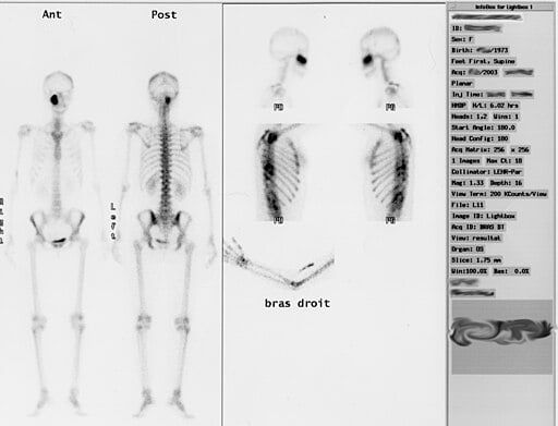 Bone scintigraphy