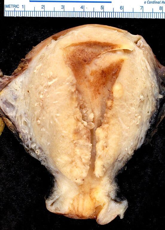 Endometrioid adenocarcinoma of the uterus FIGO grade III.jpg