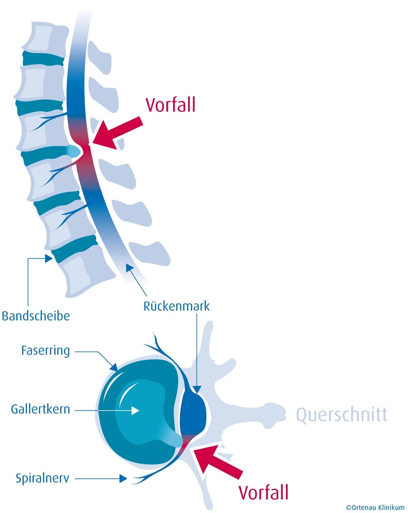 Ortenau Klinikum Bandscheibenvorfall.jpg