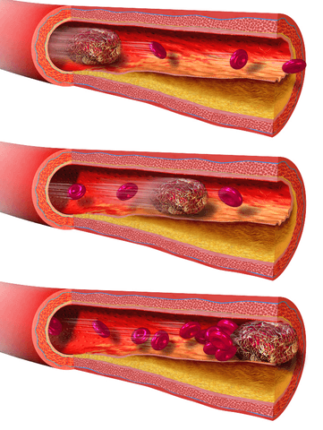 Blausen 0089 BloodClot Motion