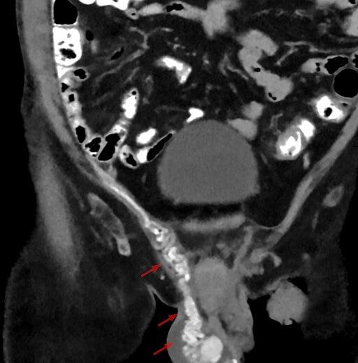 Varicocele - Coronal CT - 001