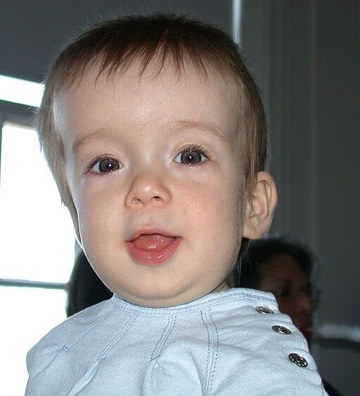 Cranialsynostosis