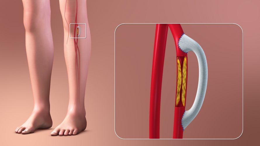 3D Medical Animation: Vascular Bypass and Grafting
