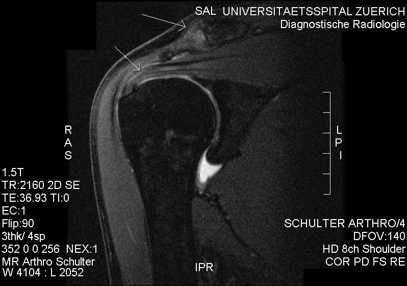 MRI. Subacromial Impingement.jpg