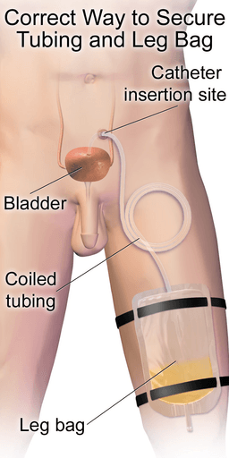 Male Suprapubic Catheter