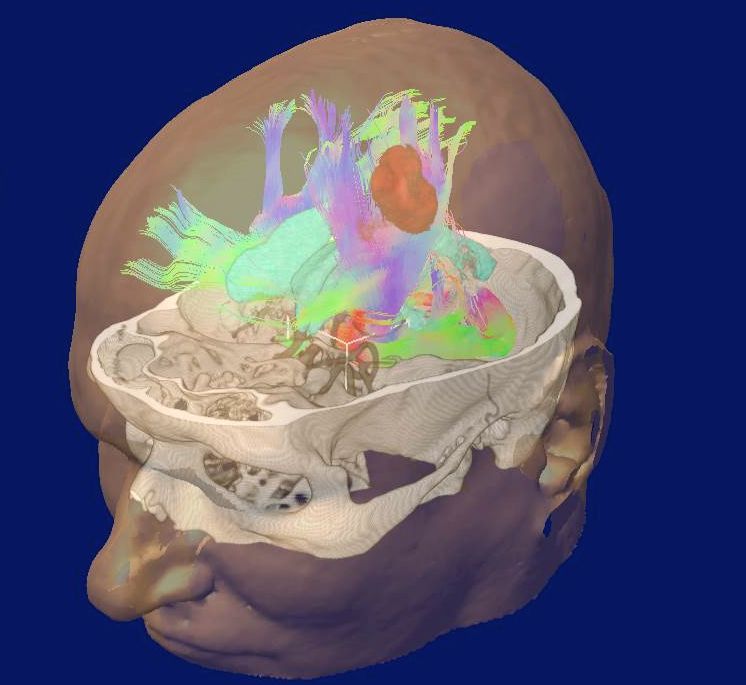 3d-Planung_Prof_Kockro.jpg 3d-Planung_Prof_Kockro.jpg