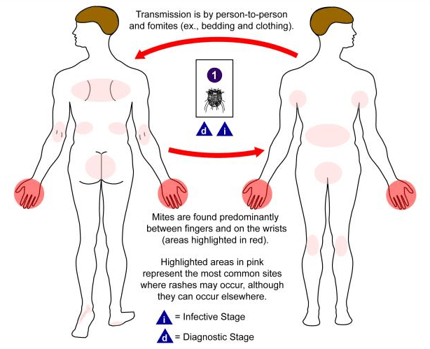 Sites of scabies