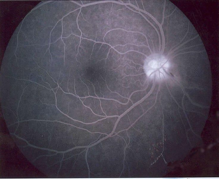 Fluoreszenzangiographie