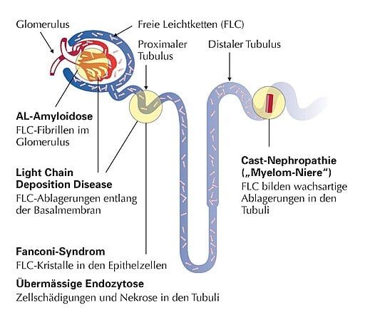 Monoklonale Gammopathien - Bedeutung in der Nephrologie - 2