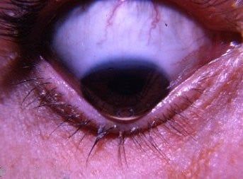 Keratokonus am Auge