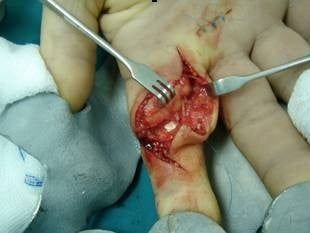 Lipoma 08.jpg