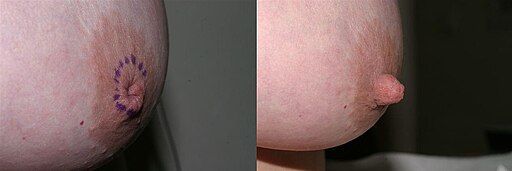 Inverted Nipples Before and After Correction