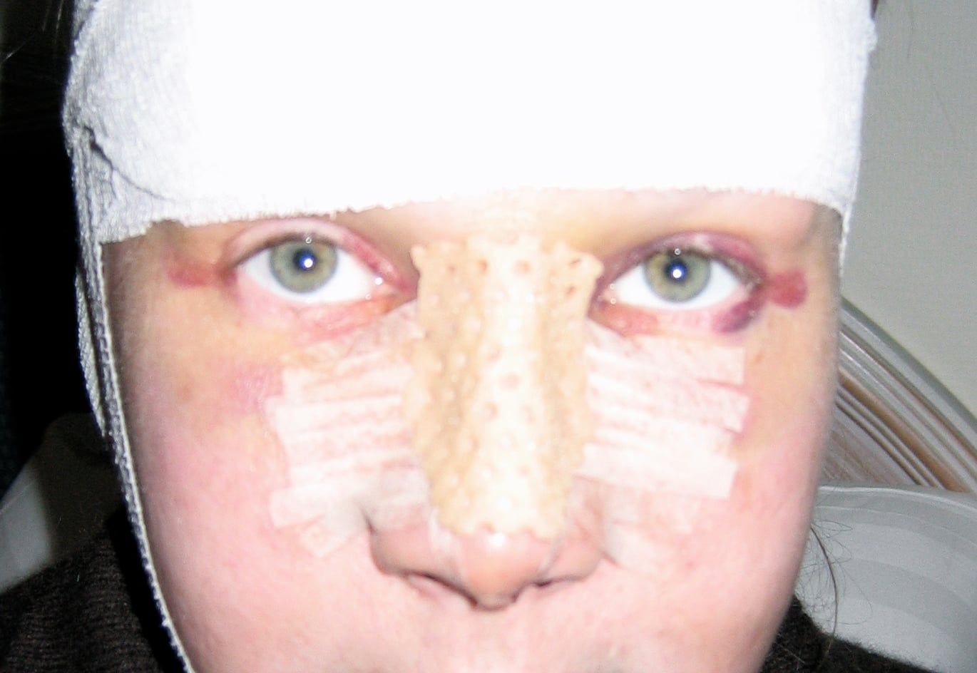 Rhinoplasty.jpg