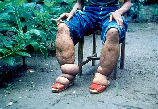 Elephantiasis