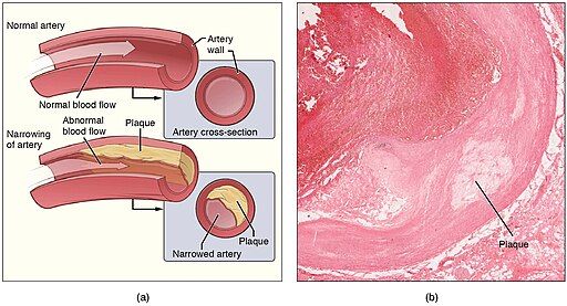 Erectile dysfunction can be a sign of atherosclerosis.