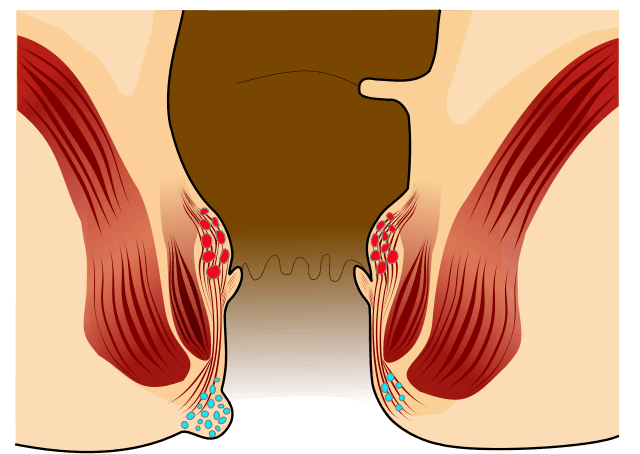 Analthrombose 01