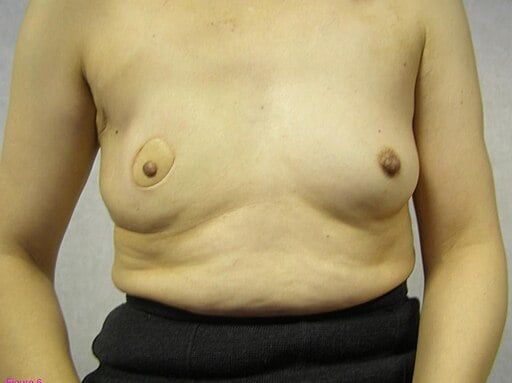 Breast reconstruction 18