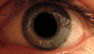 Eye dilate-thumb 300px