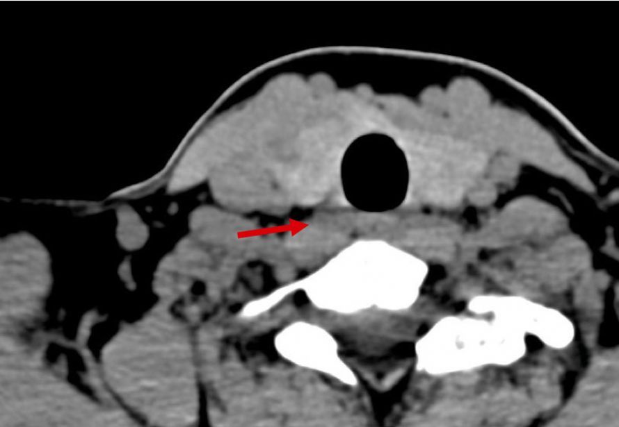 Nebenschilddrüsenadenom 4D-CT