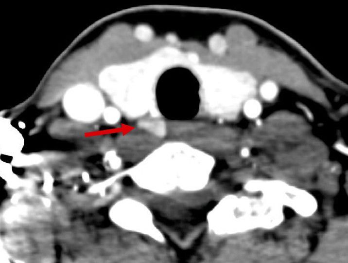 Nebenschilddrüsenadenom 4D-CT