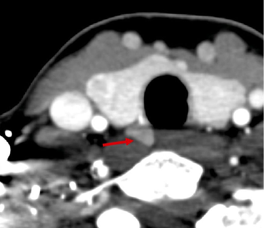 Nebenschilddrüsenadenom 4D-CT