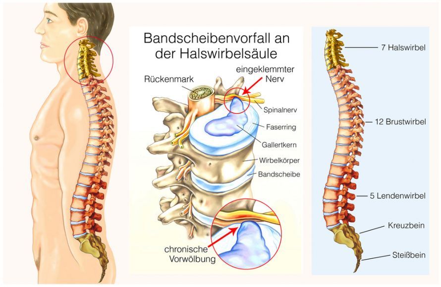 Bandscheibenvorfall Halswirbelsäule Bandscheibenvorfall Halswirbelsäule