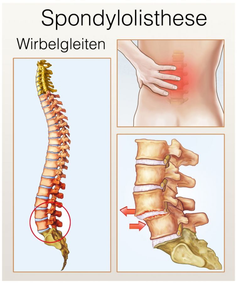 Wirbelgleiten (Spondylolisthesis) Wirbelgleiten (Spondylolisthesis)