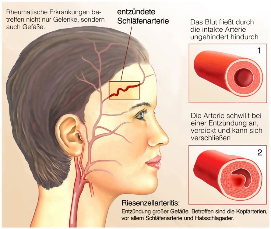 Riesenzell-Arteriitis Giant Cell Arteritis