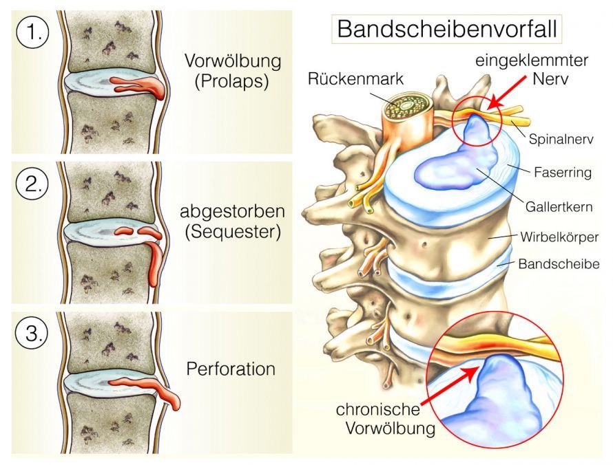 Formen verschiedener Bandscheibenvorfälle Formen verschiedener Bandscheibenvorfälle