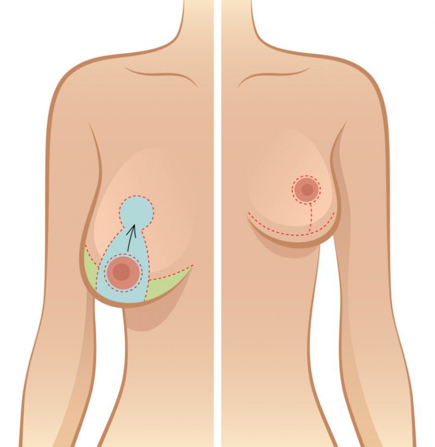 Brustverkleinerung Breast Reduction