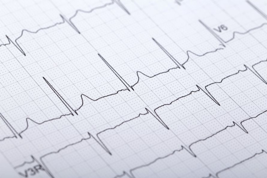 EKG Elektrokardiogramm ΗΚΓ Ηλεκτροκαρδιογράφημα