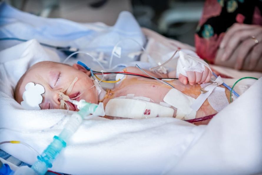 Fontan-Operation bei einem Baby