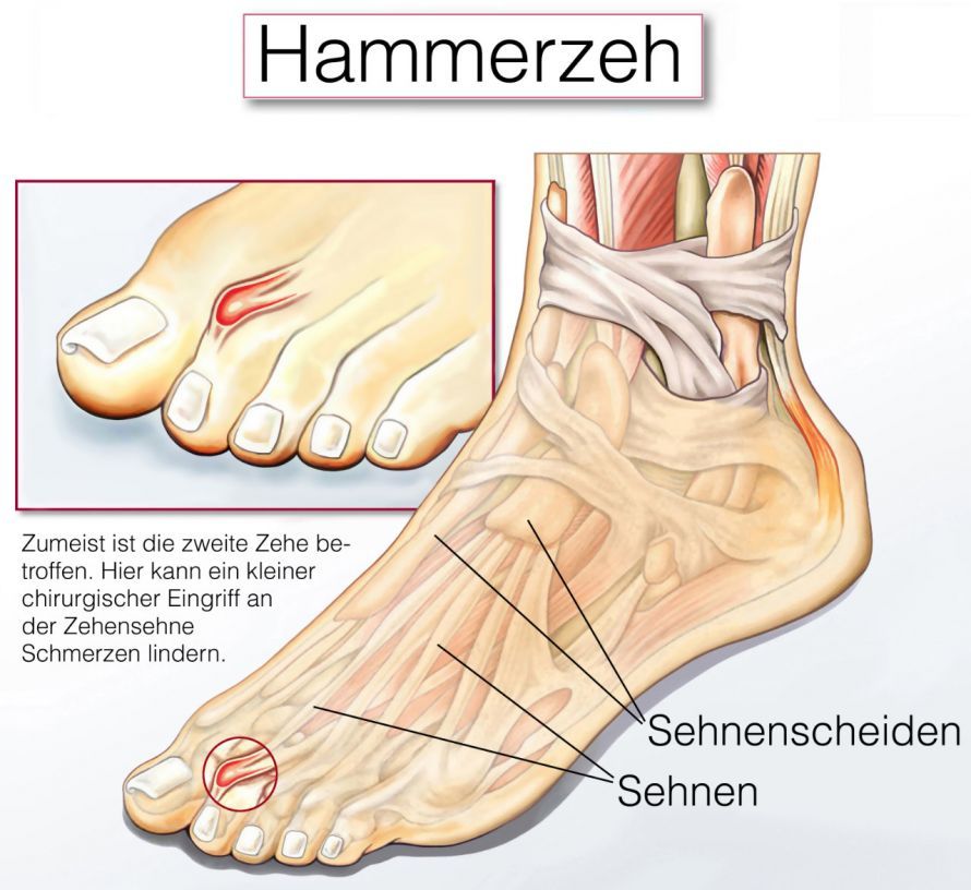 Hammerzehe Δάκτυλο σε σχήμα σφυριού