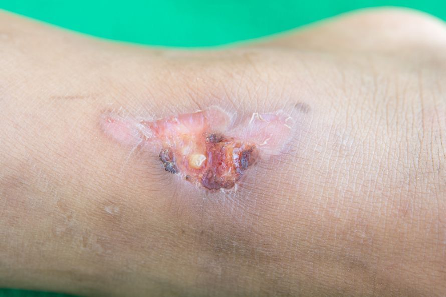 Ulcus cruris Leg ulcer