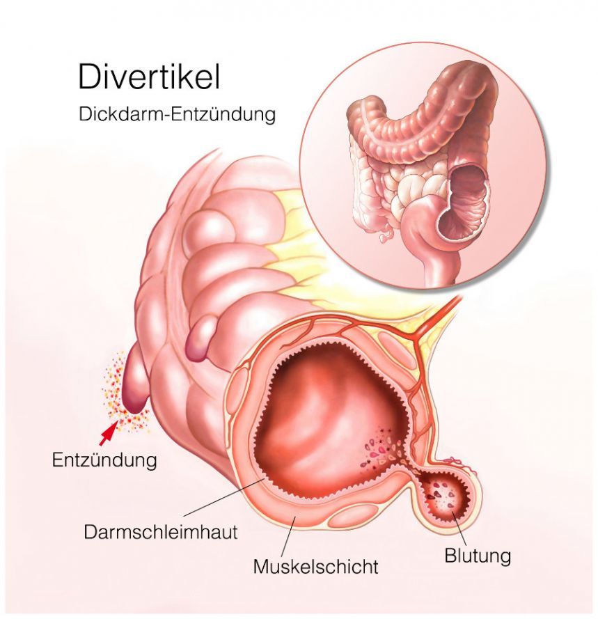 Divertikel im Dickdarm Divertikel im Dickdarm