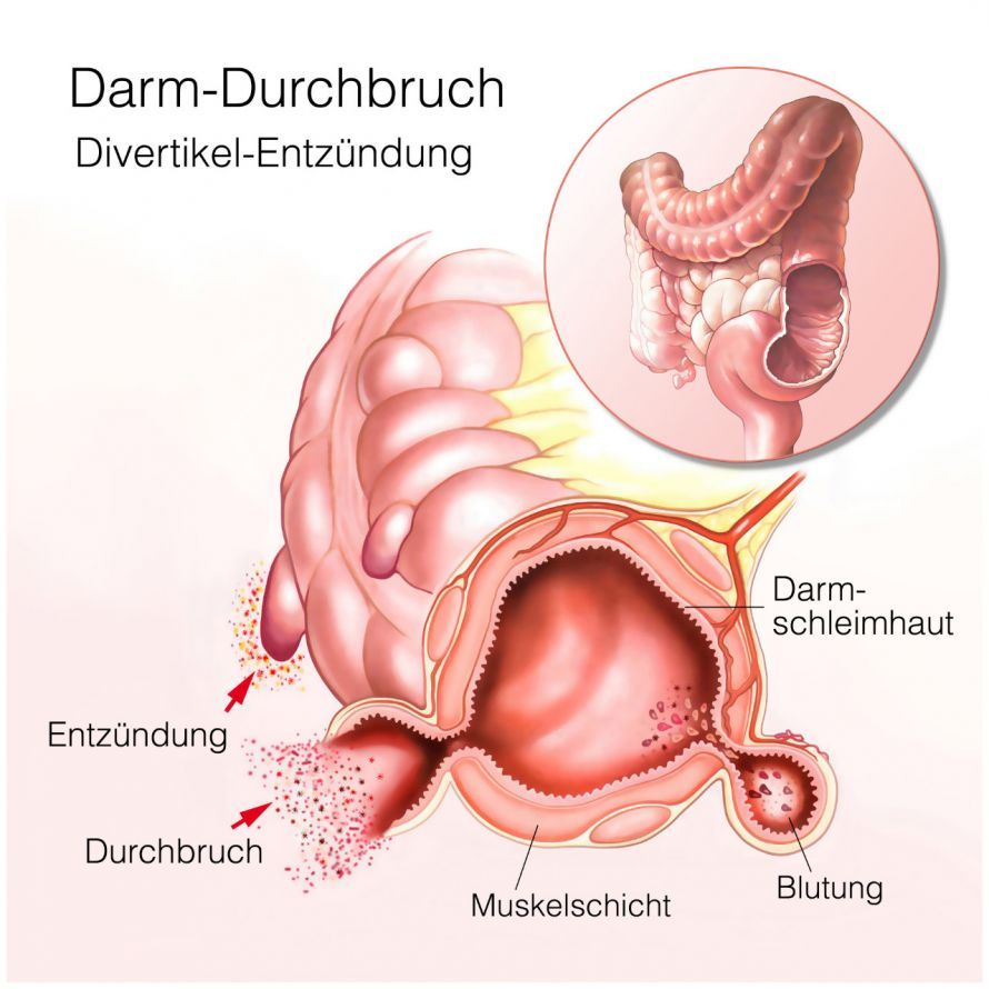 Intestinal Perforation and Diverticula
