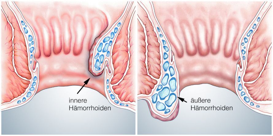 Innere und äußere Hämorrhoiden Internal and external hemorrhoids