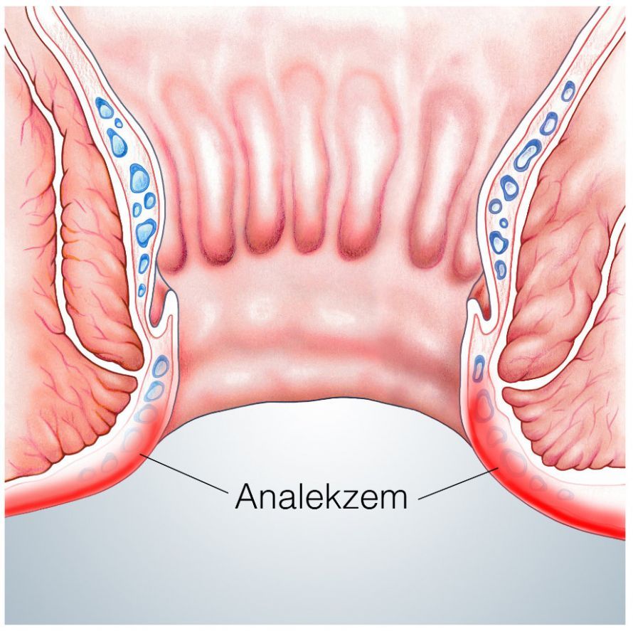 Analekzem Anal eczema