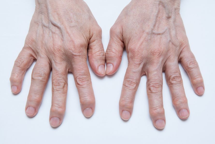 Fingergelenksarthrose
