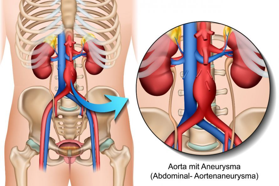 Aortenaneurysma Aortenaneurysma