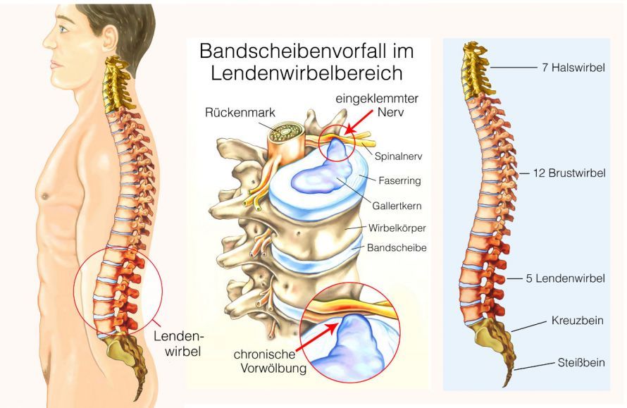 Bandscheibenvorfall in der Lendenwirbelsäule Πρόπτωση μεσοσπονδύλιου δίσκου στην οσφυϊκή μοίρα της σπονδυλικής στήλης