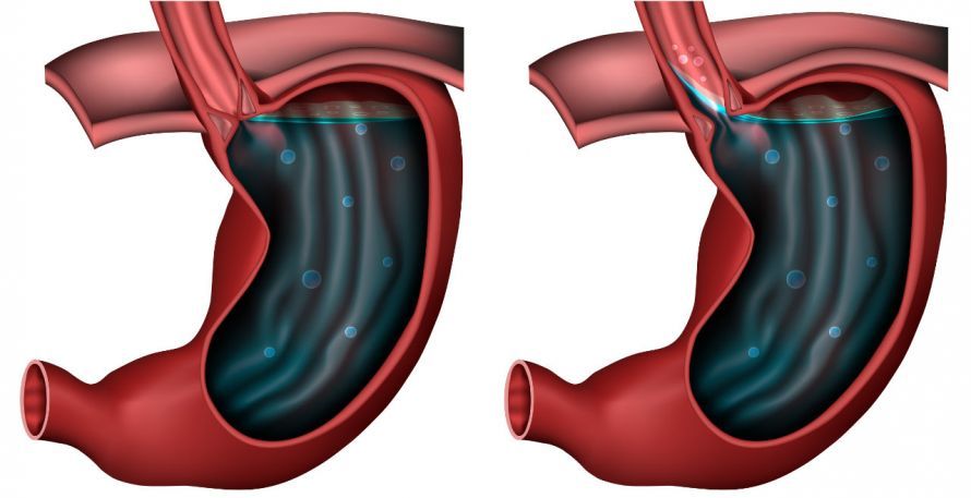Reflux Disease