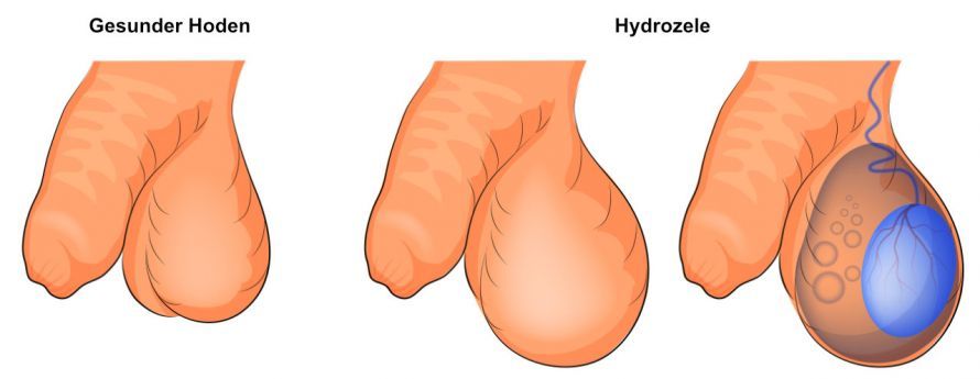 Hydrozele Υδροκήλη