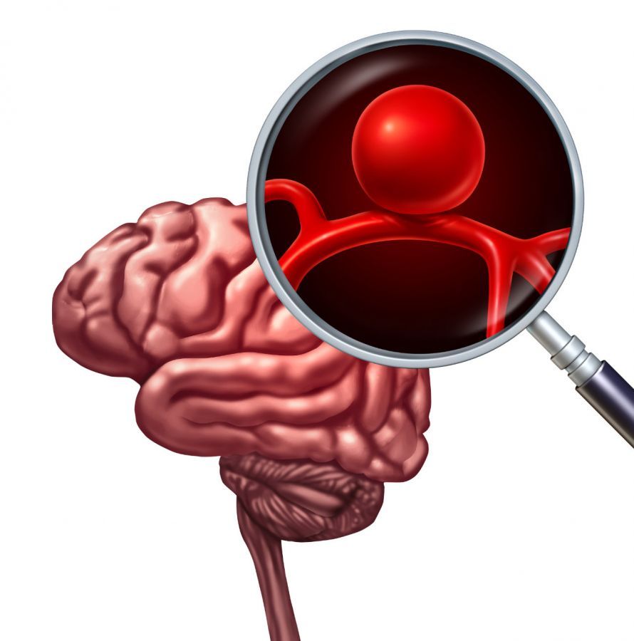 Hirnaneurysma Ανευρύσμα εγκεφάλου