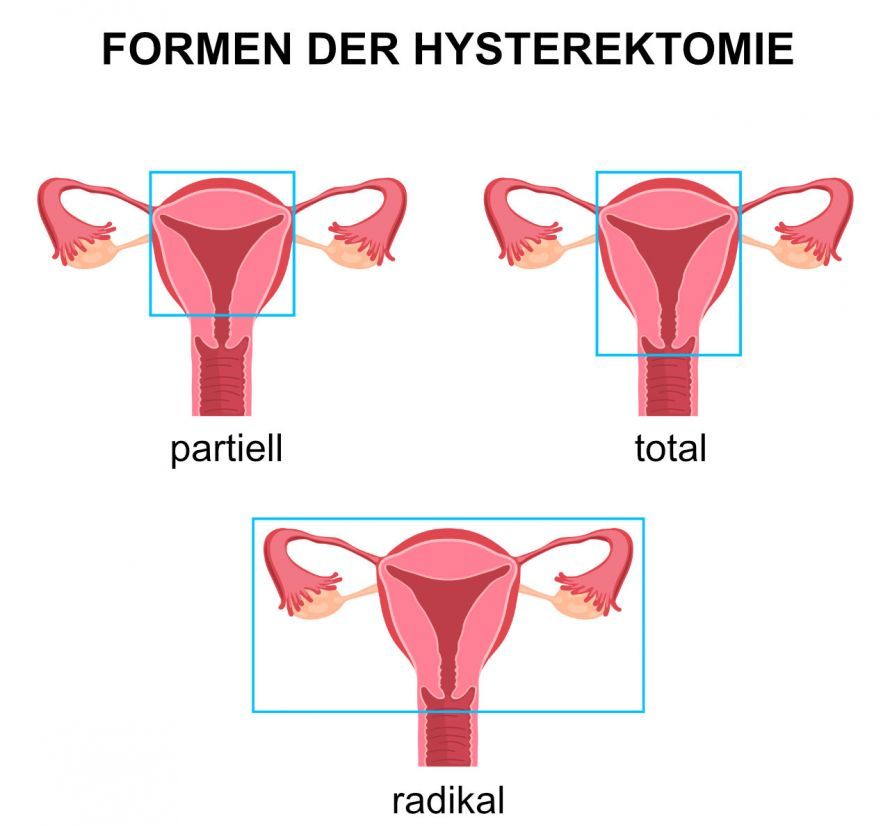 Formen der Hysterektomie Formen der Hysterektomie