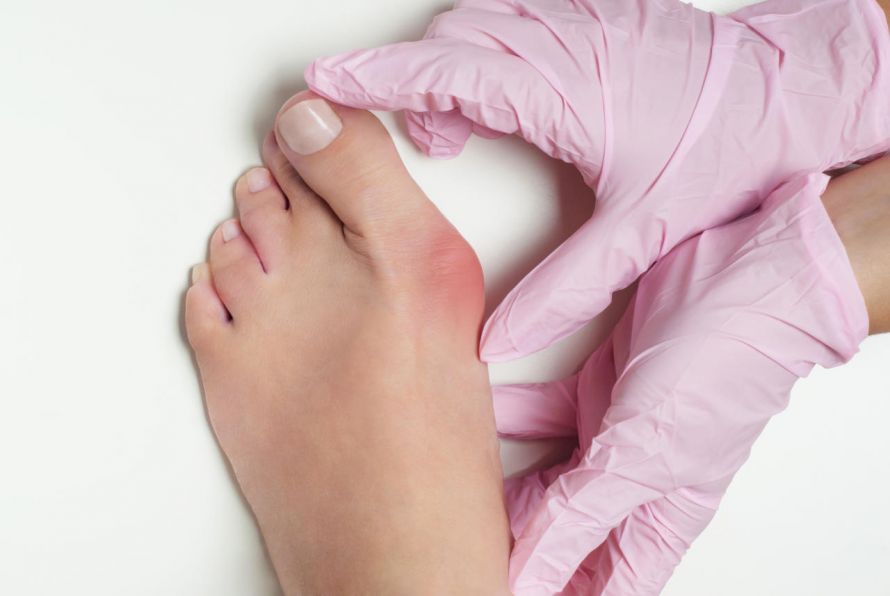 Hallux valgus Hallux valgus